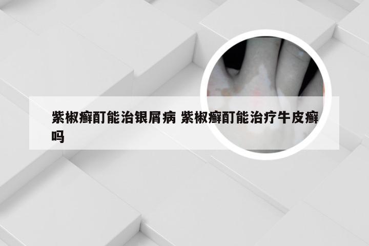 紫椒癣酊能治银屑病 紫椒癣酊能治疗牛皮癣吗