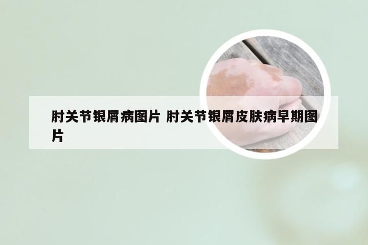 肘关节银屑病图片 肘关节银屑皮肤病早期图片