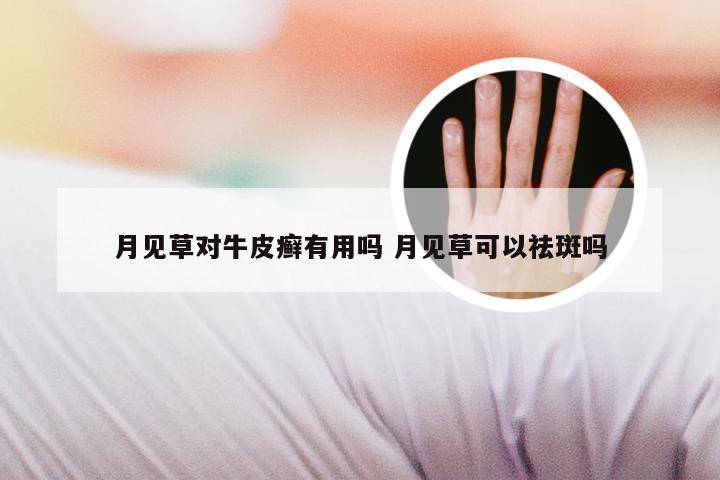 月见草对牛皮癣有用吗 月见草可以祛斑吗