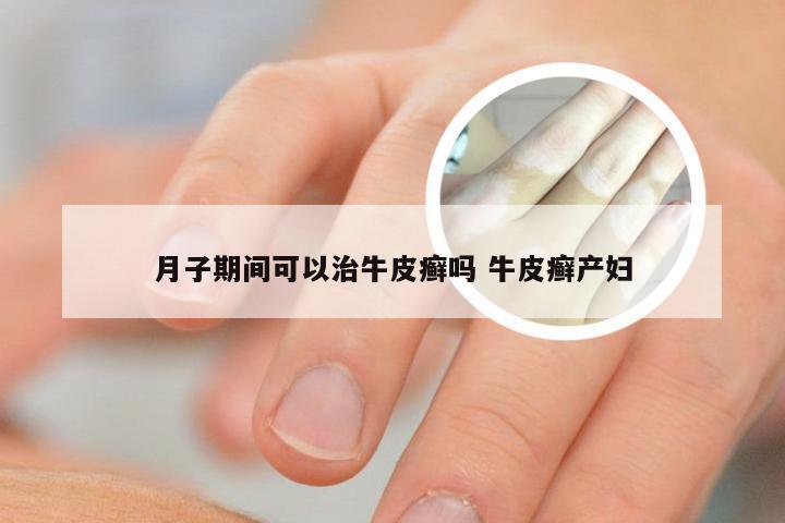 月子期间可以治牛皮癣吗 牛皮癣产妇