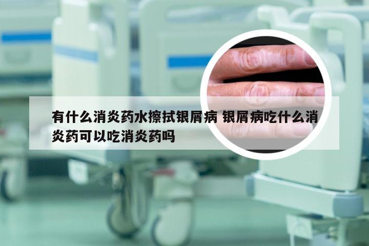 有什么消炎药水擦拭银屑病 银屑病吃什么消炎药可以吃消炎药吗