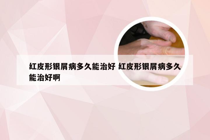 红皮形银屑病多久能治好 红皮形银屑病多久能治好啊