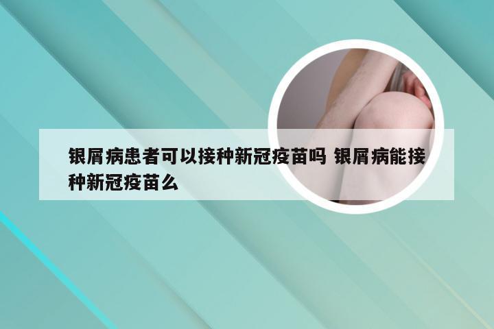 银屑病患者可以接种新冠疫苗吗 银屑病能接种新冠疫苗么