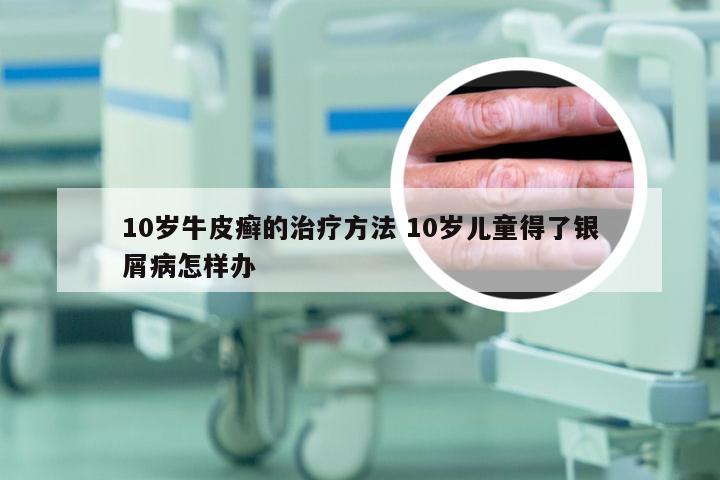 10岁牛皮癣的治疗方法 10岁儿童得了银屑病怎样办