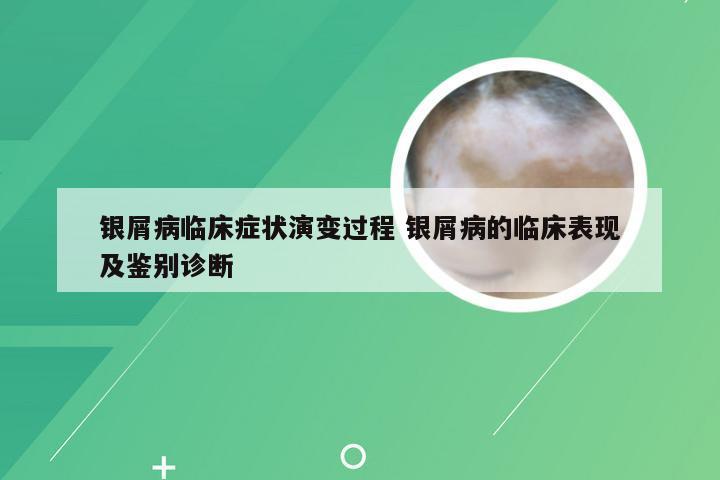 银屑病临床症状演变过程 银屑病的临床表现及鉴别诊断
