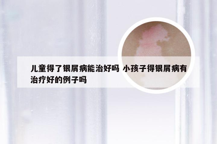 儿童得了银屑病能治好吗 小孩子得银屑病有治疗好的例子吗