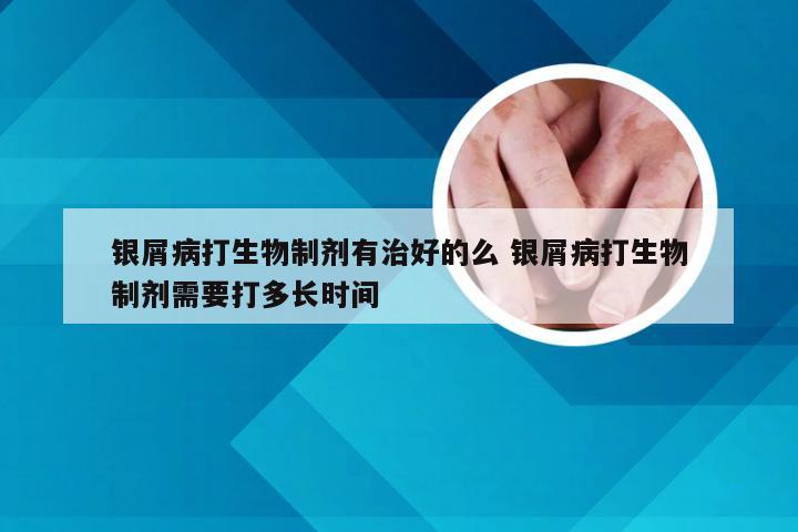 银屑病打生物制剂有治好的么 银屑病打生物制剂需要打多长时间