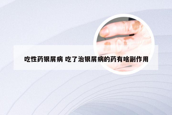 吃性药银屑病 吃了治银屑病的药有啥副作用
