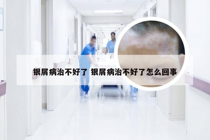 银屑病治不好了 银屑病治不好了怎么回事