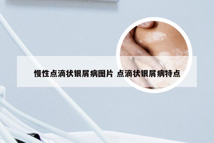 慢性点滴状银屑病图片 点滴状银屑病特点
