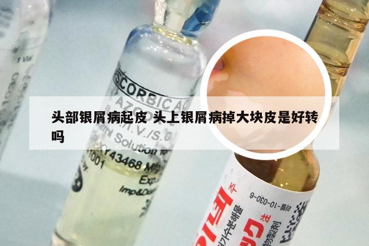 头部银屑病起皮 头上银屑病掉大块皮是好转吗
