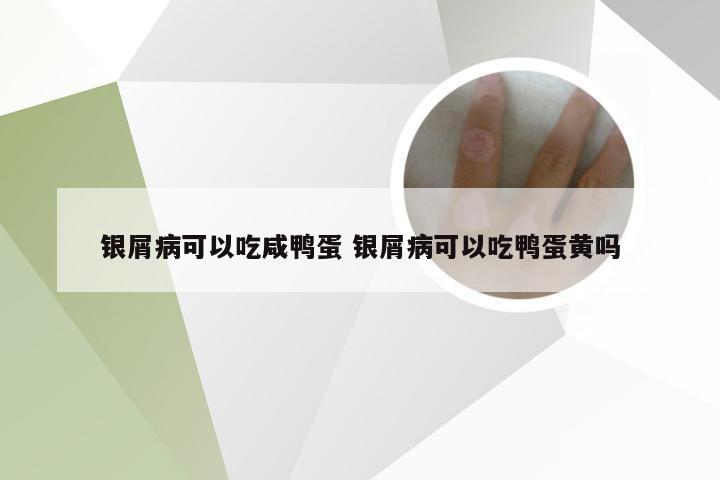 银屑病可以吃咸鸭蛋 银屑病可以吃鸭蛋黄吗