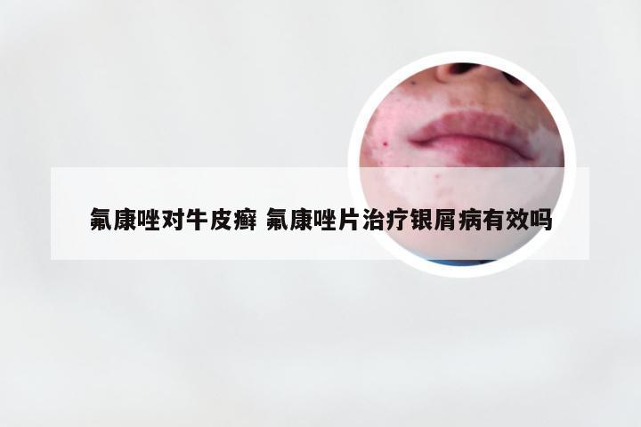 氟康唑对牛皮癣 氟康唑片治疗银屑病有效吗