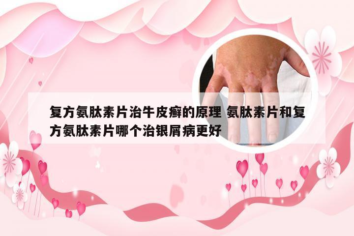 复方氨肽素片治牛皮癣的原理 氨肽素片和复方氨肽素片哪个治银屑病更好