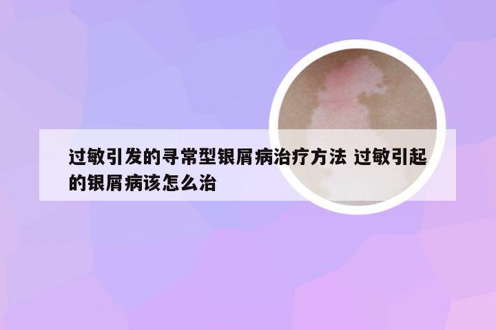 过敏引发的寻常型银屑病治疗方法 过敏引起的银屑病该怎么治
