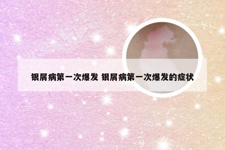 银屑病第一次爆发 银屑病第一次爆发的症状