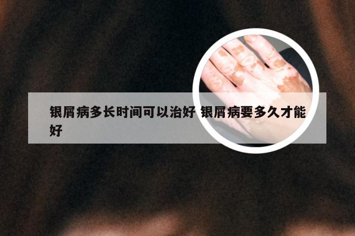 银屑病多长时间可以治好 银屑病要多久才能好