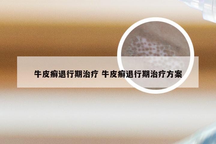 牛皮癣退行期治疗 牛皮癣退行期治疗方案