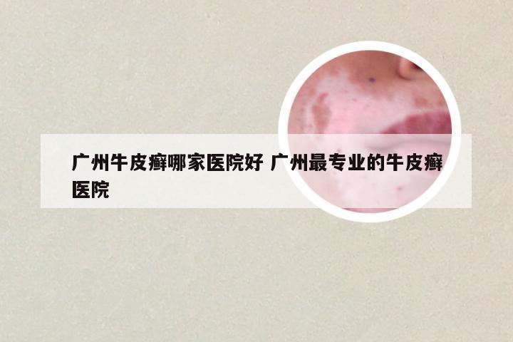 广州牛皮癣哪家医院好 广州最专业的牛皮癣医院