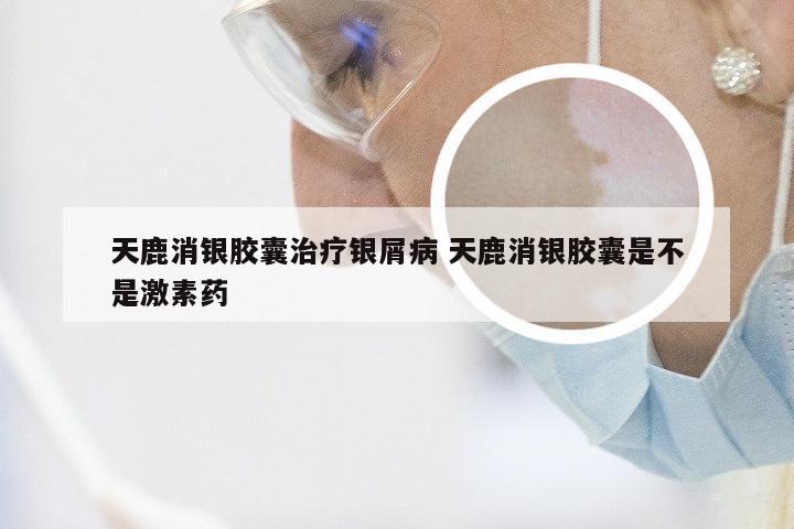 天鹿消银胶囊治疗银屑病 天鹿消银胶囊是不是激素药