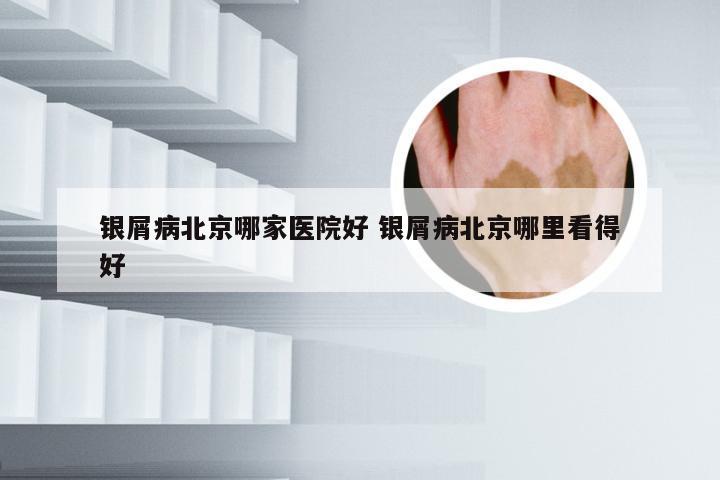 银屑病北京哪家医院好 银屑病北京哪里看得好