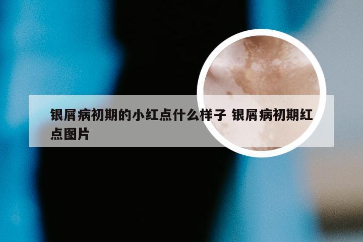 银屑病初期的小红点什么样子 银屑病初期红点图片