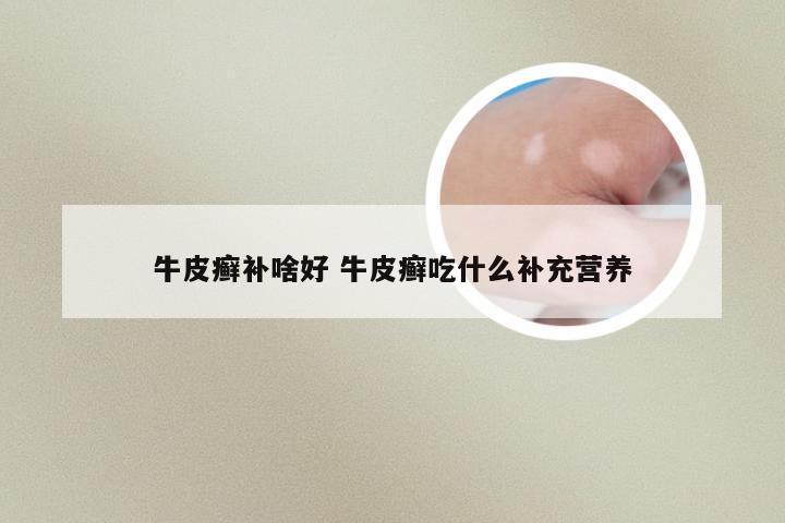 牛皮癣补啥好 牛皮癣吃什么补充营养