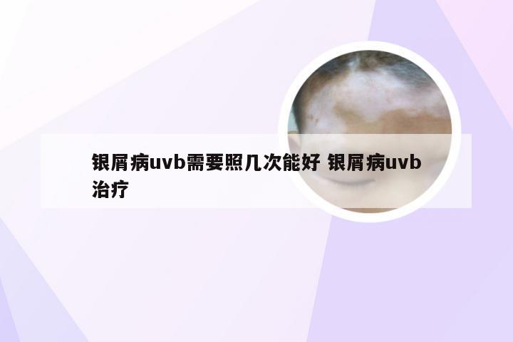 银屑病uvb需要照几次能好 银屑病uvb治疗