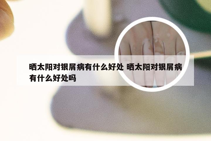 晒太阳对银屑病有什么好处 晒太阳对银屑病有什么好处吗