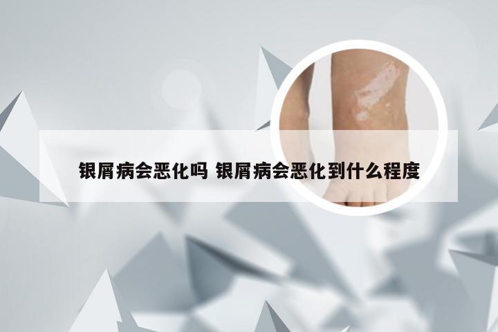 银屑病会恶化吗 银屑病会恶化到什么程度