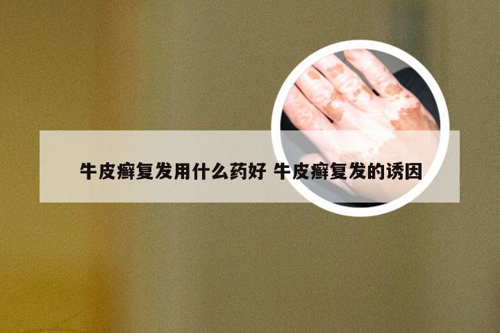 牛皮癣复发用什么药好 牛皮癣复发的诱因