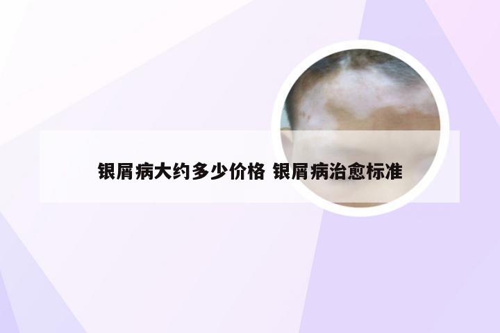 银屑病大约多少价格 银屑病治愈标准