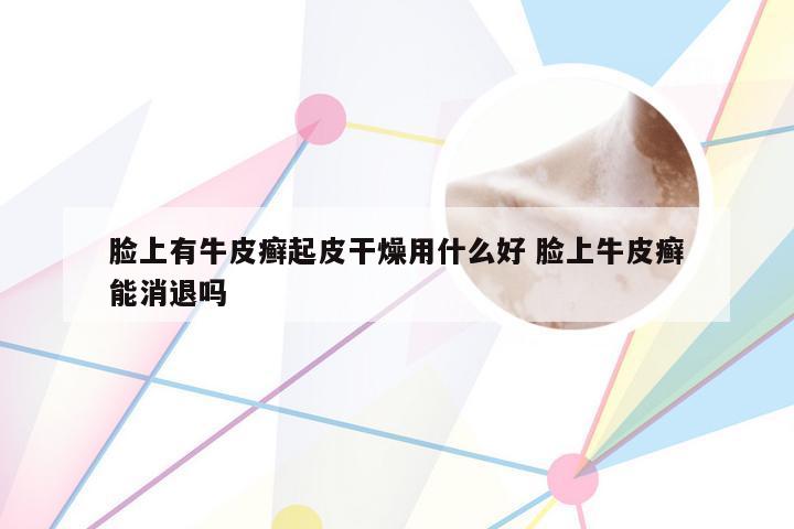 脸上有牛皮癣起皮干燥用什么好 脸上牛皮癣能消退吗
