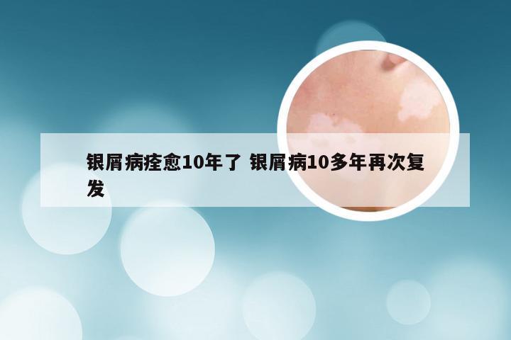 银屑病痊愈10年了 银屑病10多年再次复发