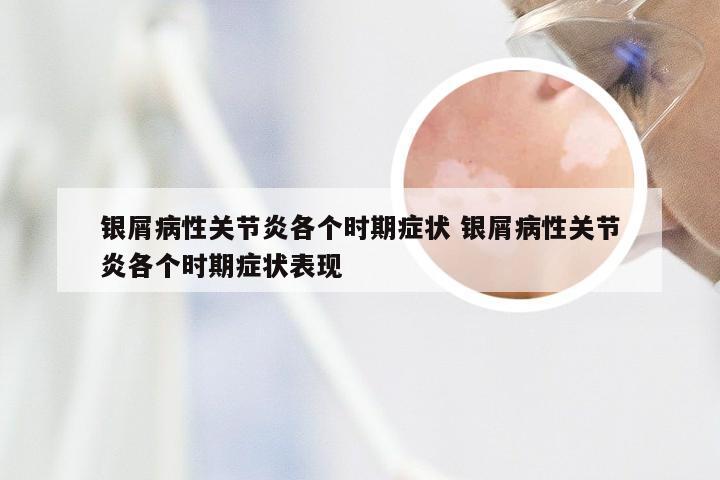 银屑病性关节炎各个时期症状 银屑病性关节炎各个时期症状表现