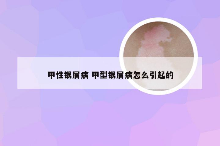 甲性银屑病 甲型银屑病怎么引起的