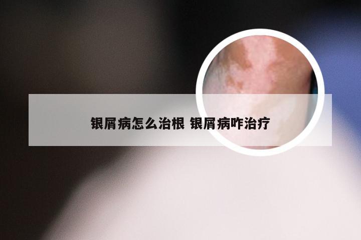 银屑病怎么治根 银屑病咋治疗
