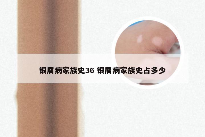 银屑病家族史36 银屑病家族史占多少