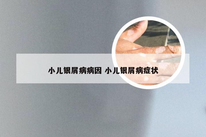 小儿银屑病病因 小儿银屑病症状