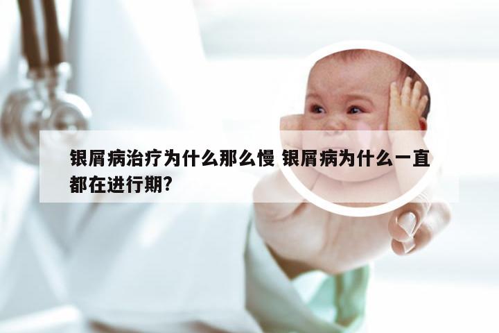 银屑病治疗为什么那么慢 银屑病为什么一直都在进行期?