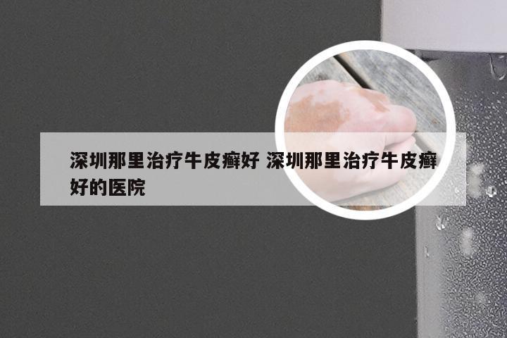 深圳那里治疗牛皮癣好 深圳那里治疗牛皮癣好的医院