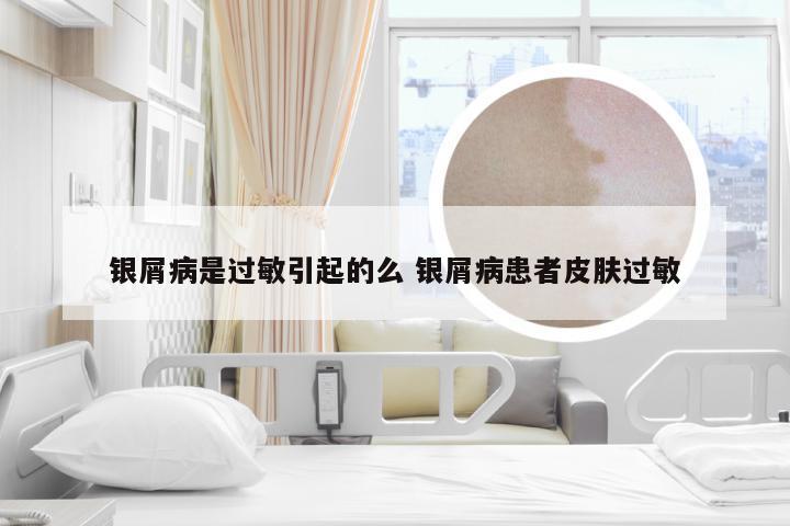 银屑病是过敏引起的么 银屑病患者皮肤过敏