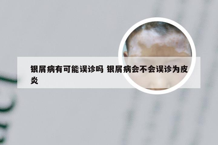 银屑病有可能误诊吗 银屑病会不会误诊为皮炎
