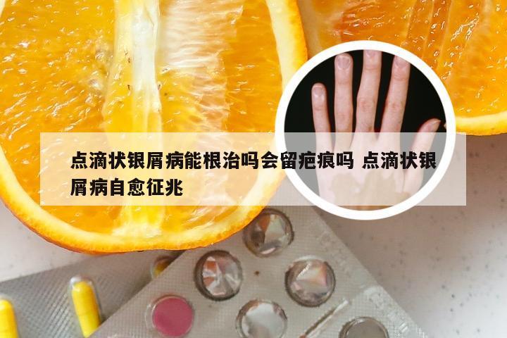 点滴状银屑病能根治吗会留疤痕吗 点滴状银屑病自愈征兆