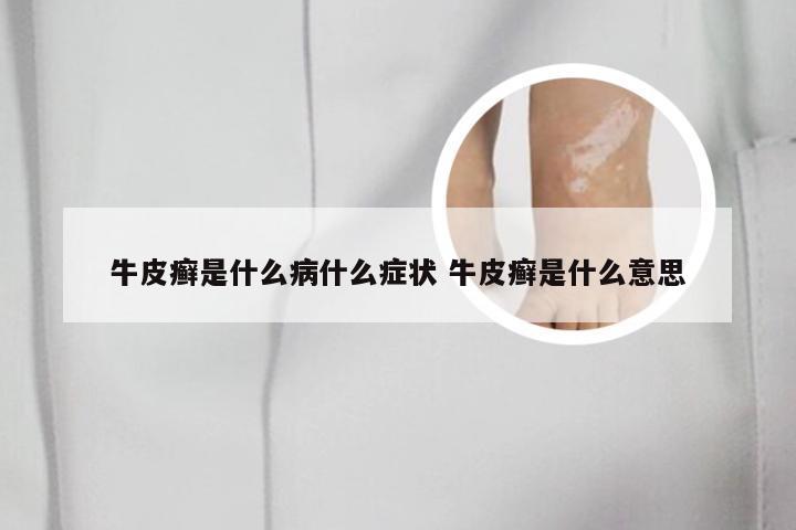 牛皮癣是什么病什么症状 牛皮癣是什么意思