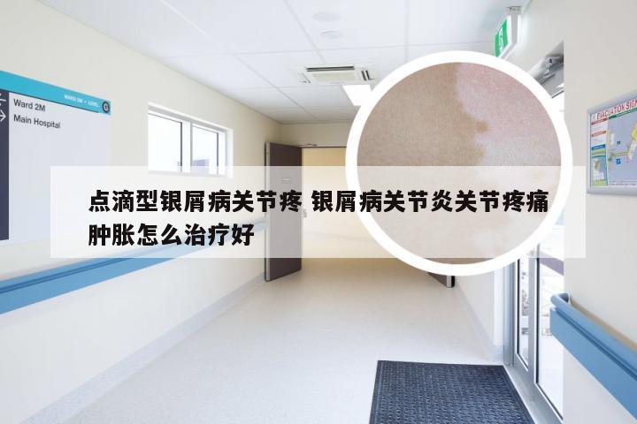 点滴型银屑病关节疼 银屑病关节炎关节疼痛肿胀怎么治疗好