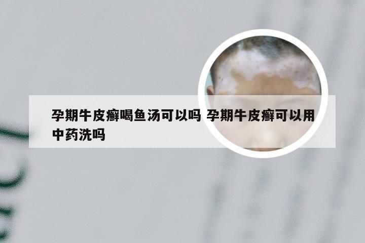 孕期牛皮癣喝鱼汤可以吗 孕期牛皮癣可以用中药洗吗