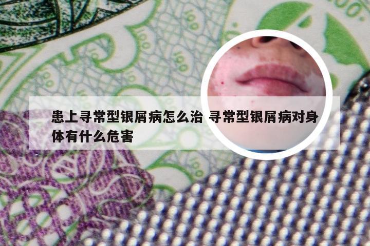 患上寻常型银屑病怎么治 寻常型银屑病对身体有什么危害