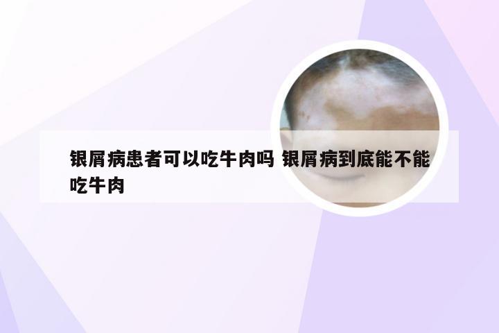 银屑病患者可以吃牛肉吗 银屑病到底能不能吃牛肉