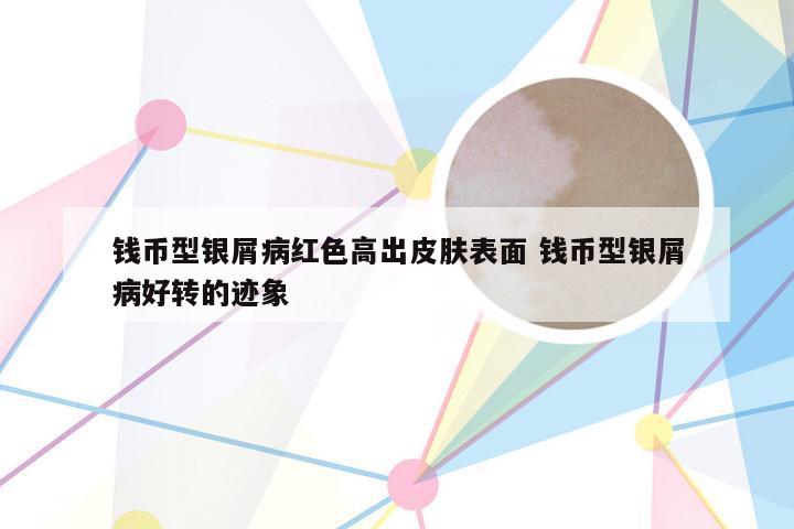 钱币型银屑病红色高出皮肤表面 钱币型银屑病好转的迹象